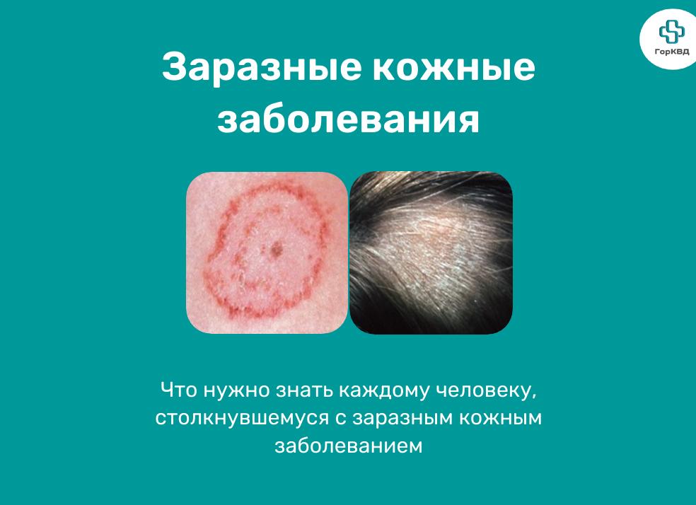 Стригущий лишай у человека. симптомы, причины, лечение для взрослых и детей